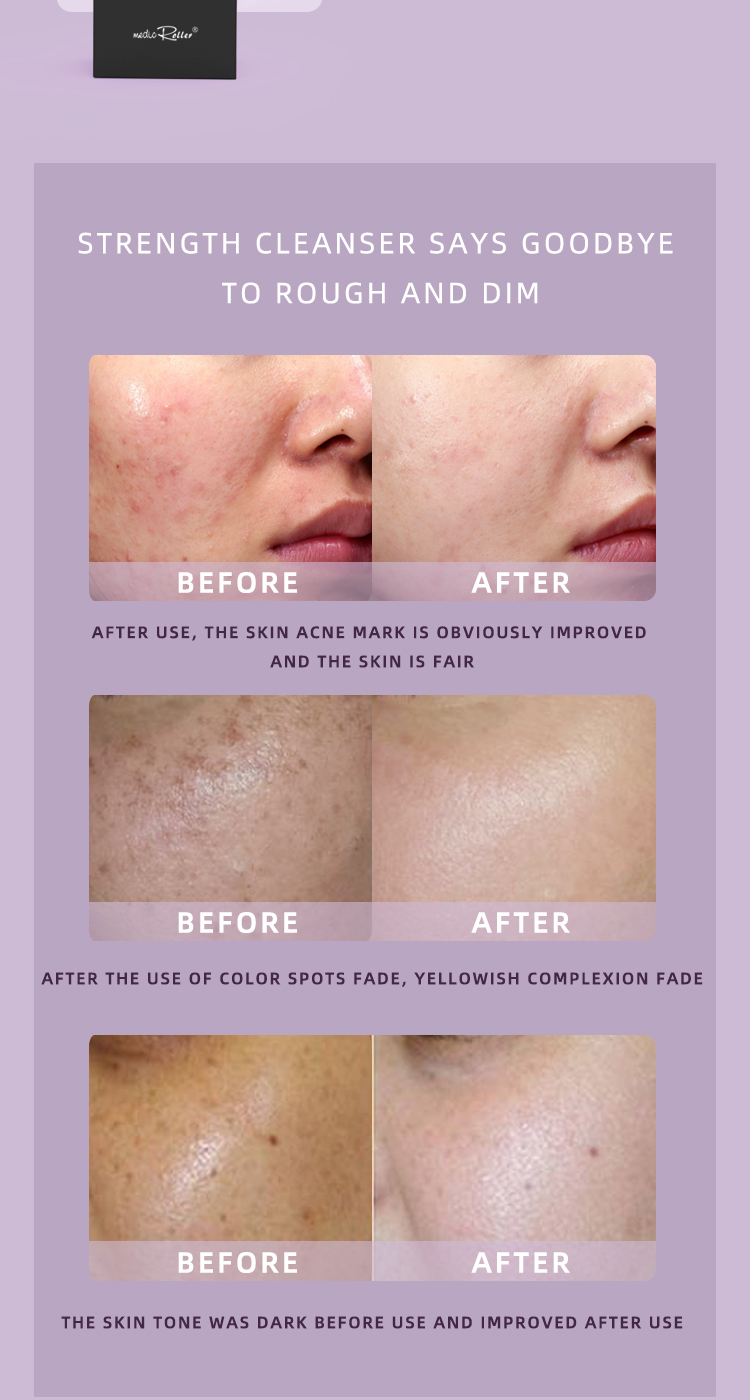 Before use vs after use, after use, the skin acne marks are significantly improved, the skin is bright and white;After use, the spots are lightened, yellow skin is lightened;Before use, the complexion is dull, and after use, it is obviously improved.
